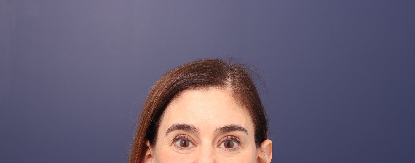 Brow lift Before & After Image
