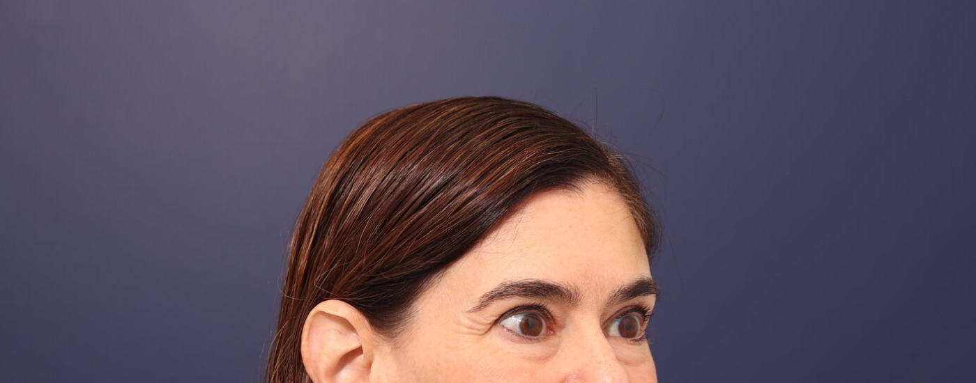 Brow lift Before & After Image