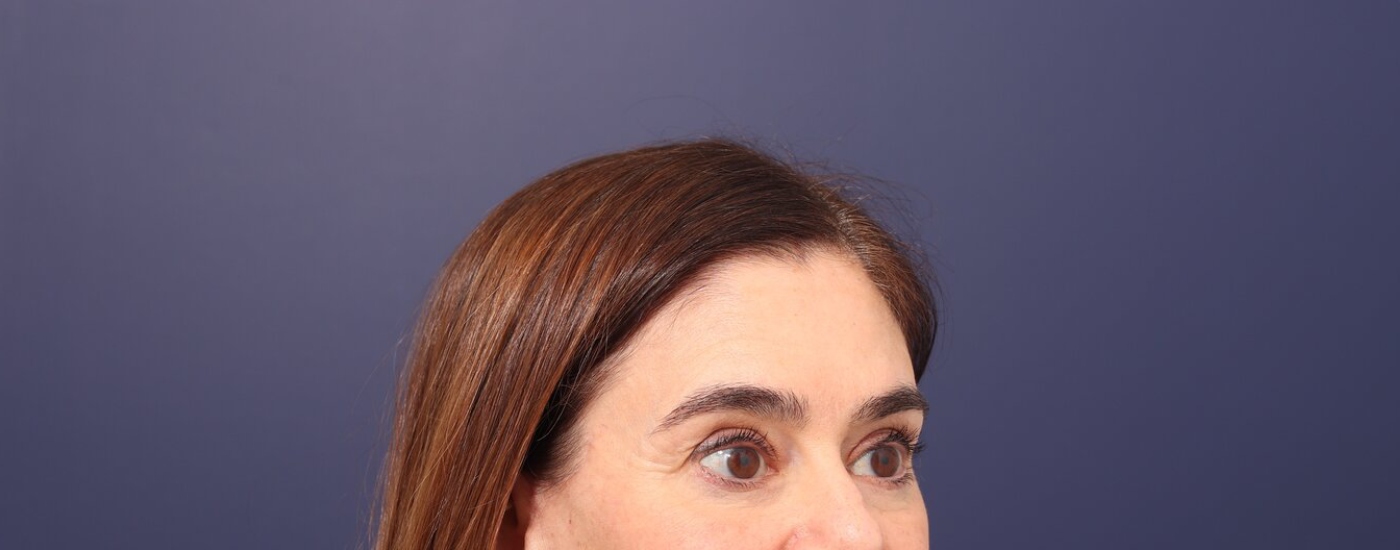 Brow lift Before & After Image