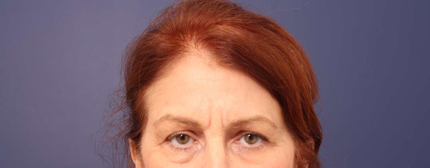 Brow lift Before & After Image