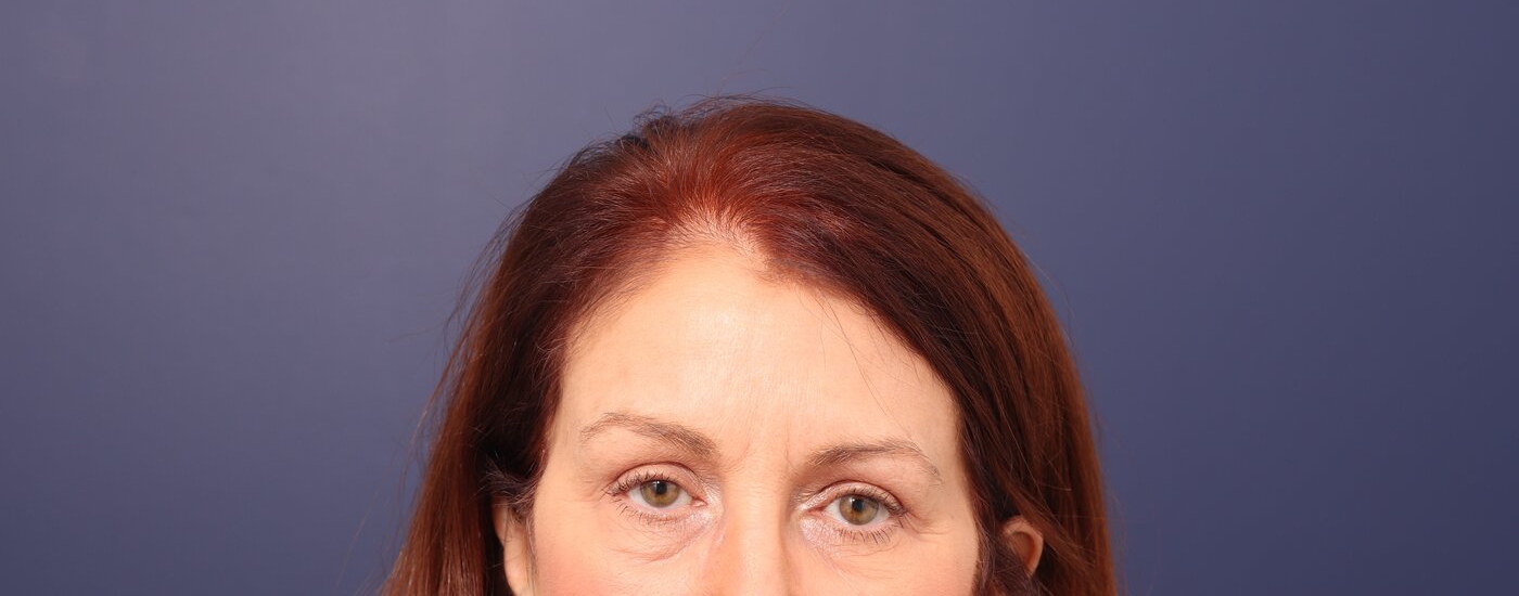 Brow lift Before & After Image