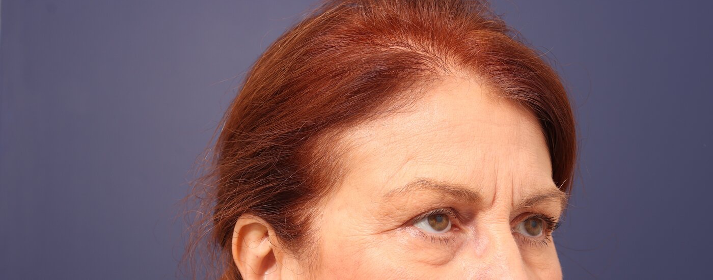 Brow lift Before & After Image