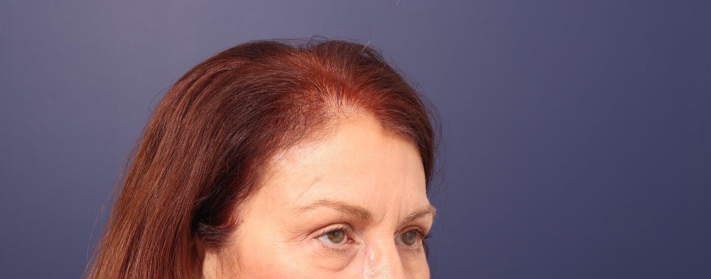Brow lift Before & After Image