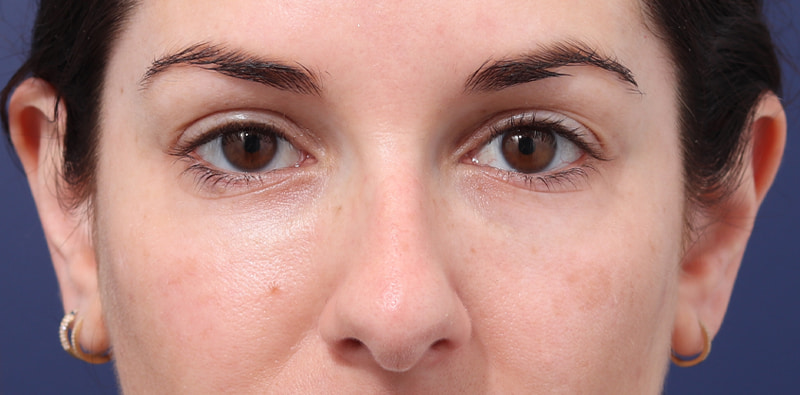 Rhinoplasty Before & After Image