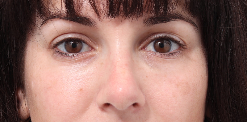 Rhinoplasty Before & After Image