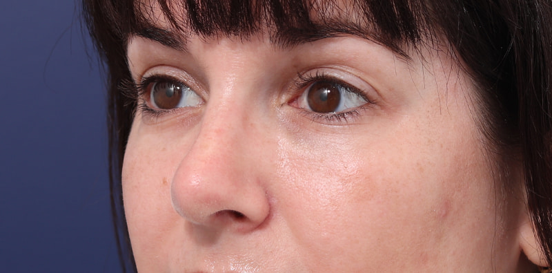 Rhinoplasty Before & After Image