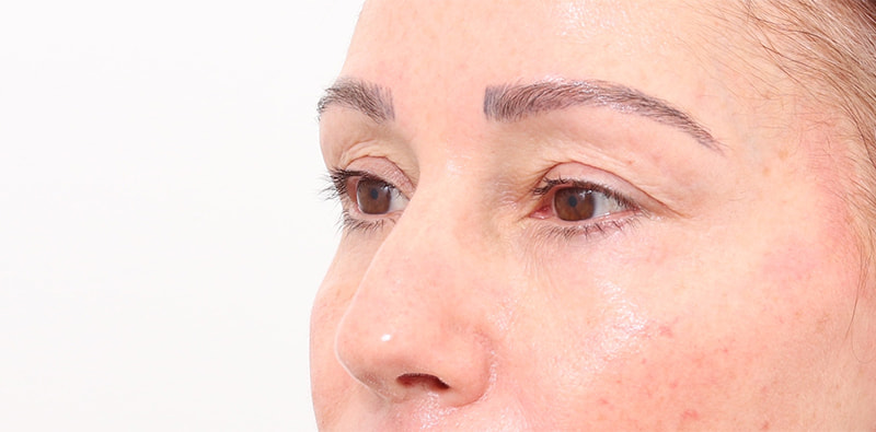 Rhinoplasty Before & After Image