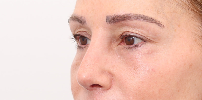 Rhinoplasty Before & After Image