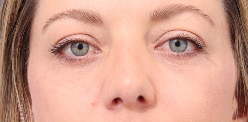 Rhinoplasty Before & After Image