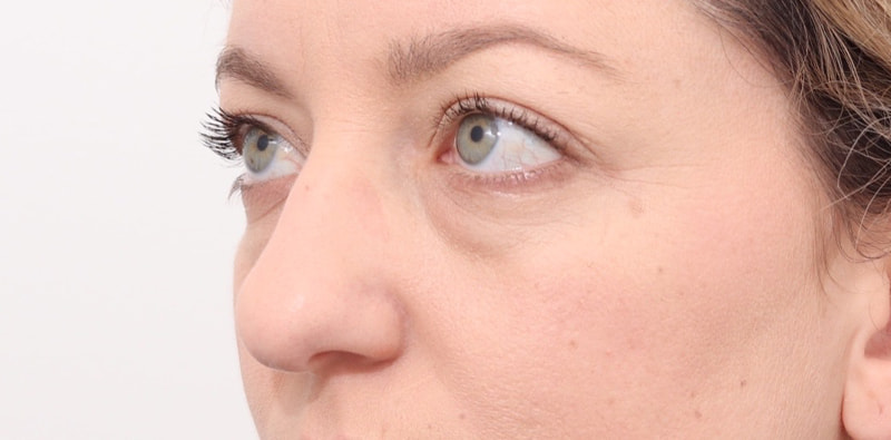 Rhinoplasty Before & After Image