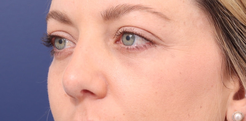 Rhinoplasty Before & After Image