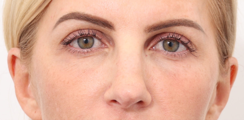 Rhinoplasty Before & After Image