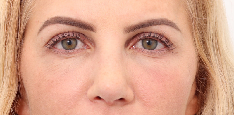 Rhinoplasty Before & After Image