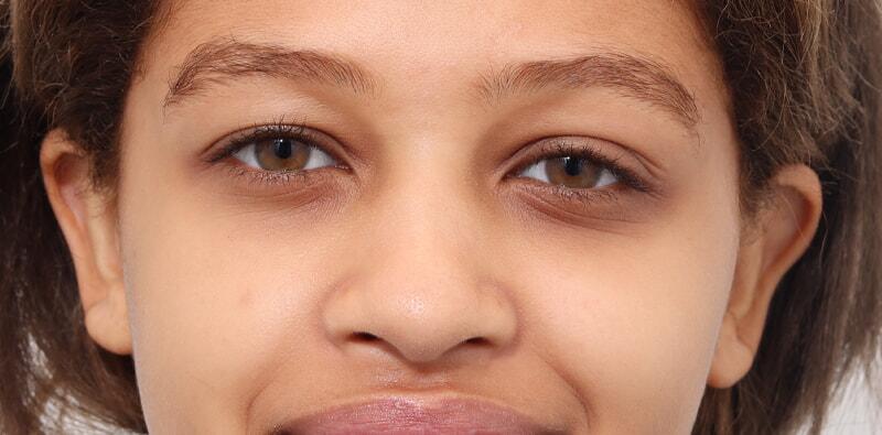 Rhinoplasty Before & After Image