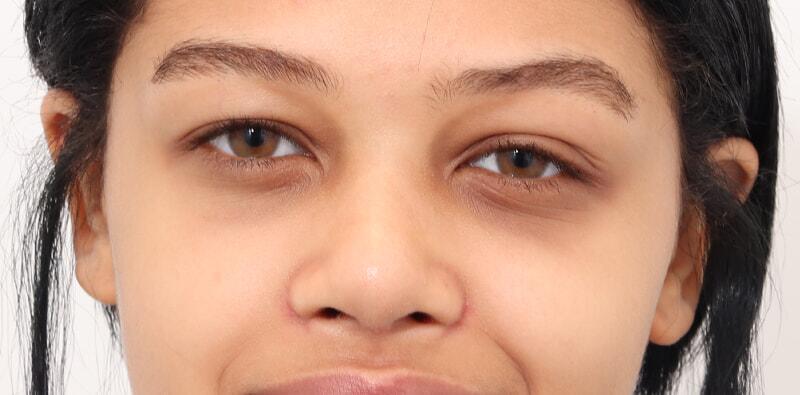 Rhinoplasty Before & After Image