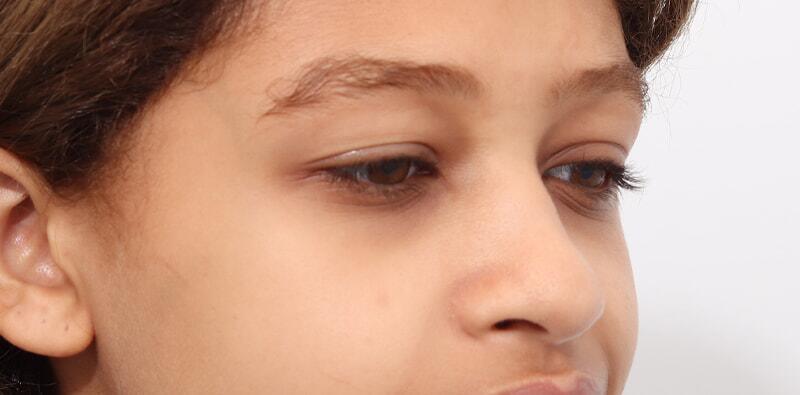 Rhinoplasty Before & After Image