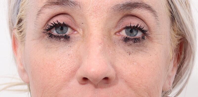 Rhinoplasty Before & After Image