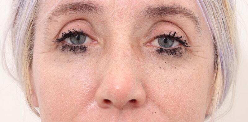 Rhinoplasty Before & After Image