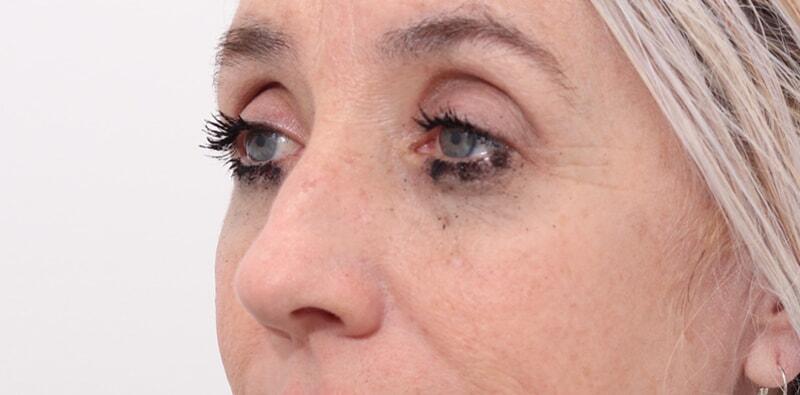 Rhinoplasty Before & After Image