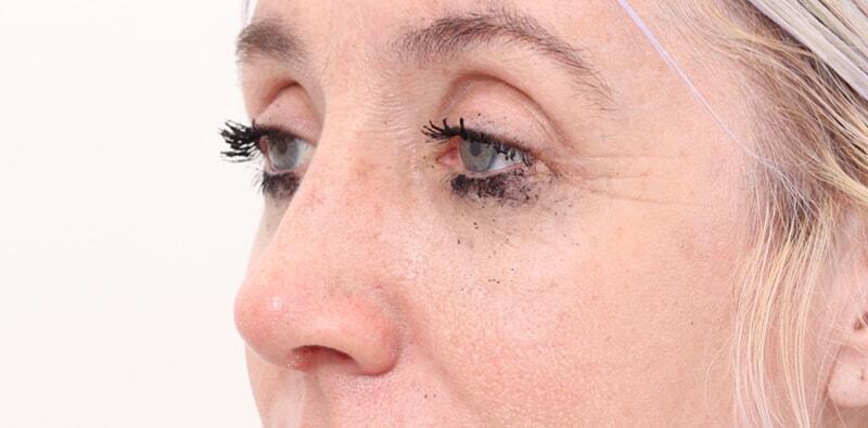 Rhinoplasty Before & After Image