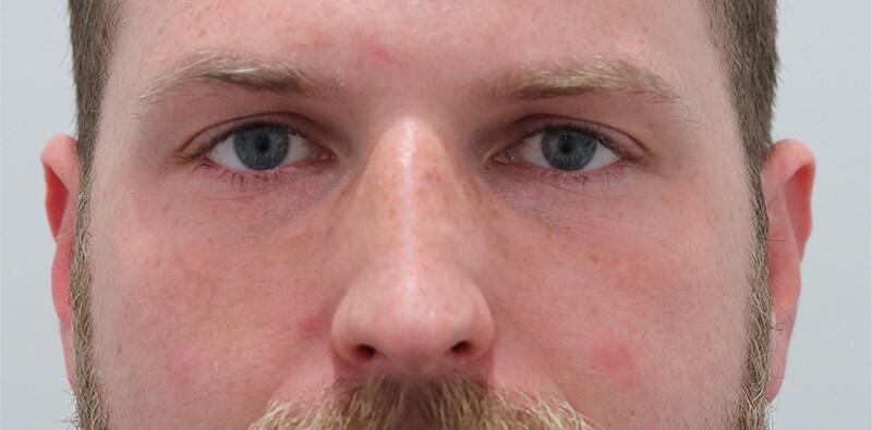 Rhinoplasty Before & After Image