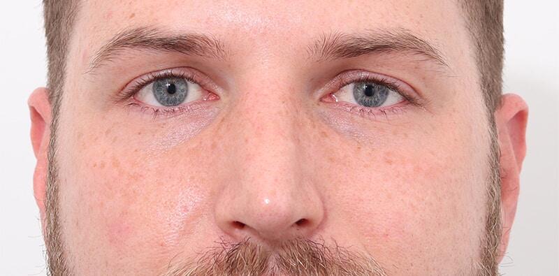 Rhinoplasty Before & After Image