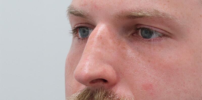 Rhinoplasty Before & After Image