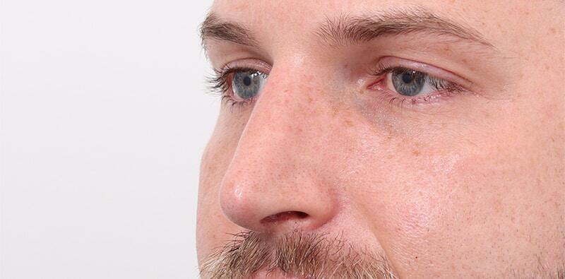 Rhinoplasty Before & After Image