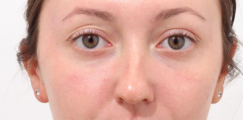 Rhinoplasty Before & After Image