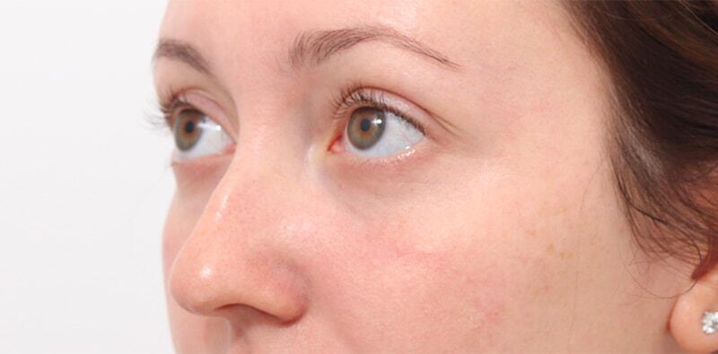 Rhinoplasty Before & After Image