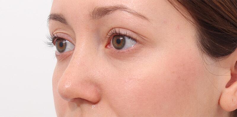 Rhinoplasty Before & After Image