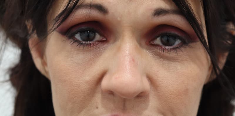 Rhinoplasty Before & After Image