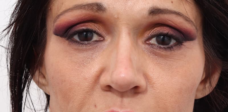 Rhinoplasty Before & After Image