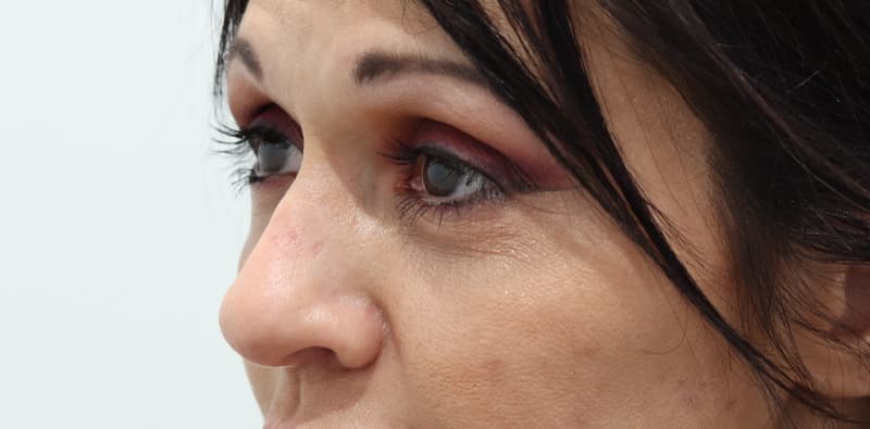 Rhinoplasty Before & After Image