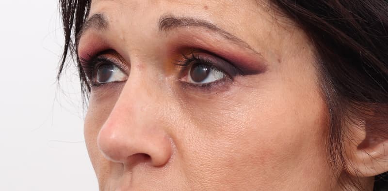 Rhinoplasty Before & After Image