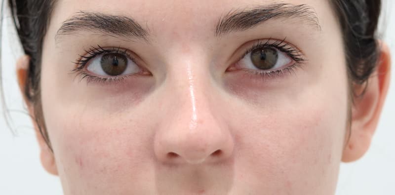 Rhinoplasty Before & After Image