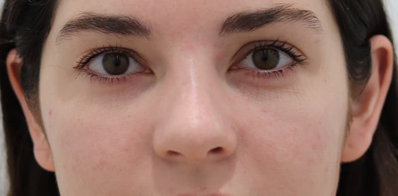 Rhinoplasty Before & After Image