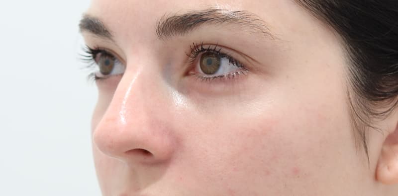 Rhinoplasty Before & After Image