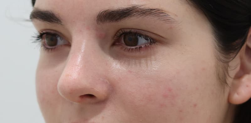 Rhinoplasty Before & After Image