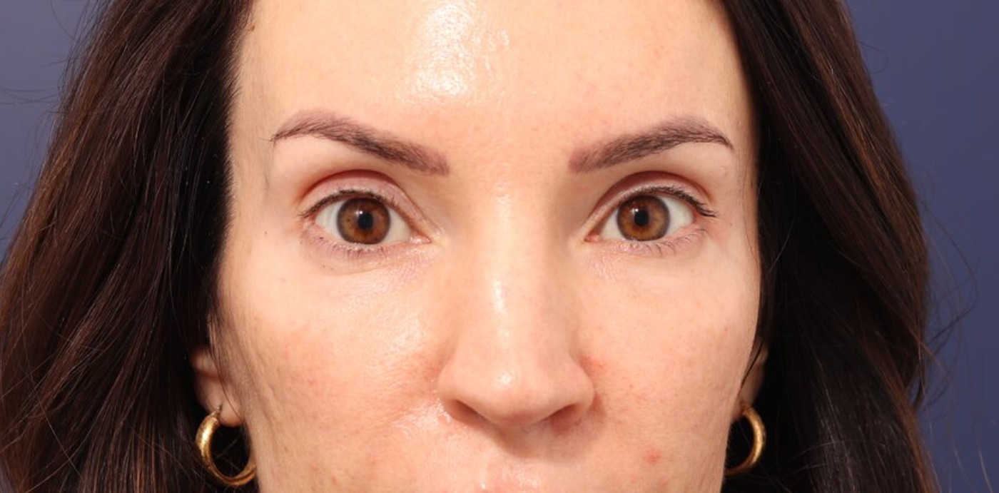 Rhinoplasty Before & After Image