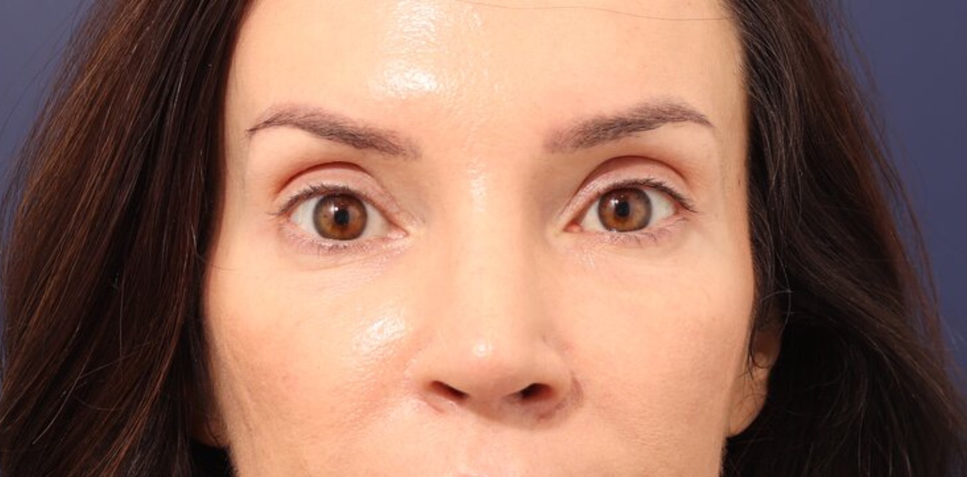 Rhinoplasty Before & After Image