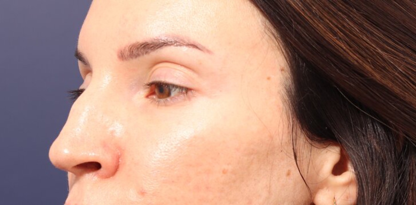 Rhinoplasty Before & After Image