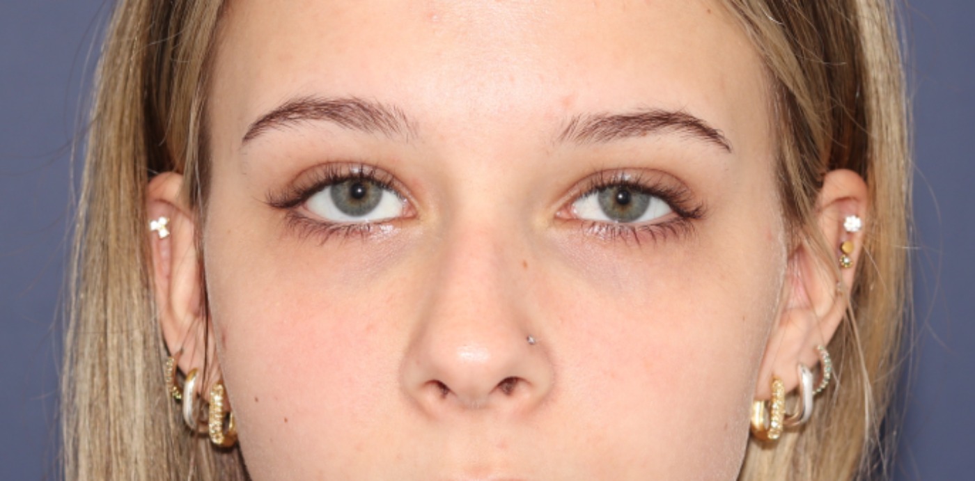 Rhinoplasty Before & After Image