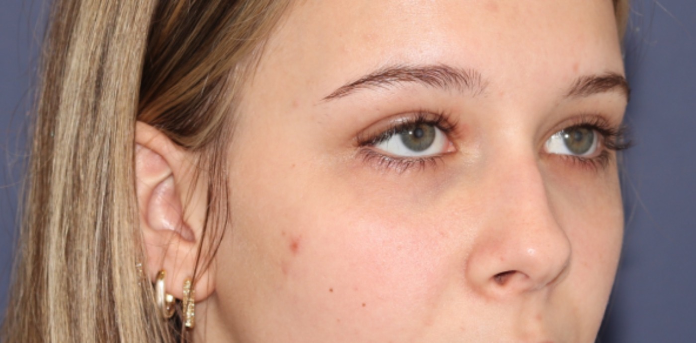 Rhinoplasty Before & After Image