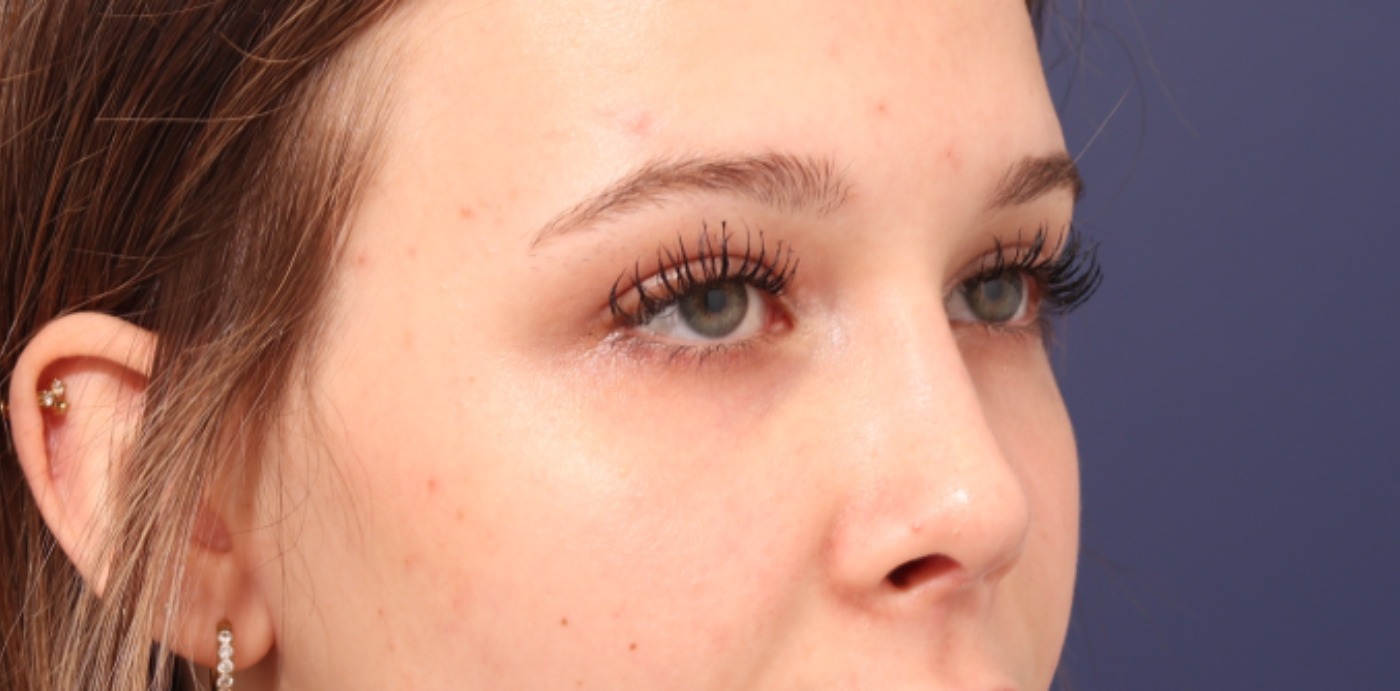 Rhinoplasty Before & After Image