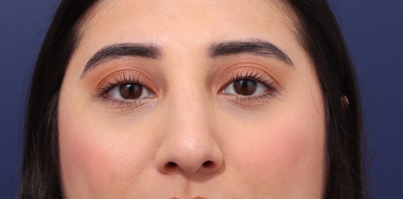 Rhinoplasty Before & After Image