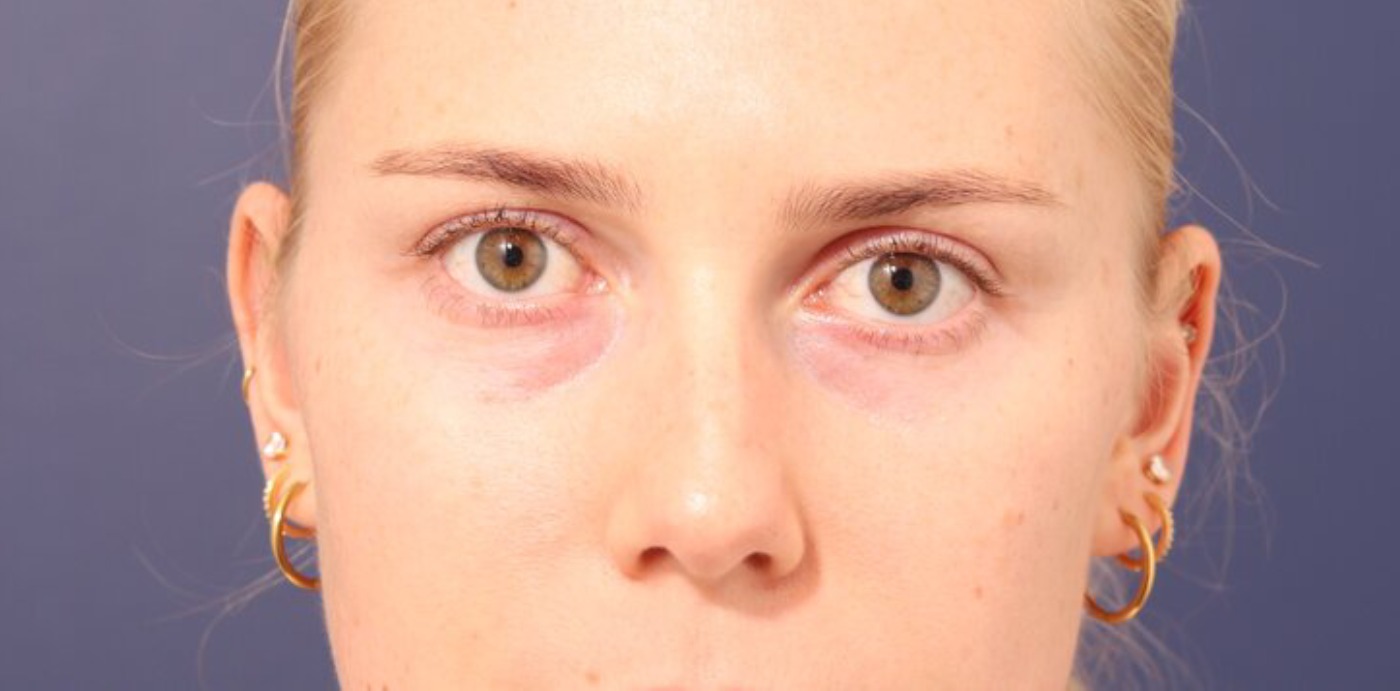 Rhinoplasty Before & After Image