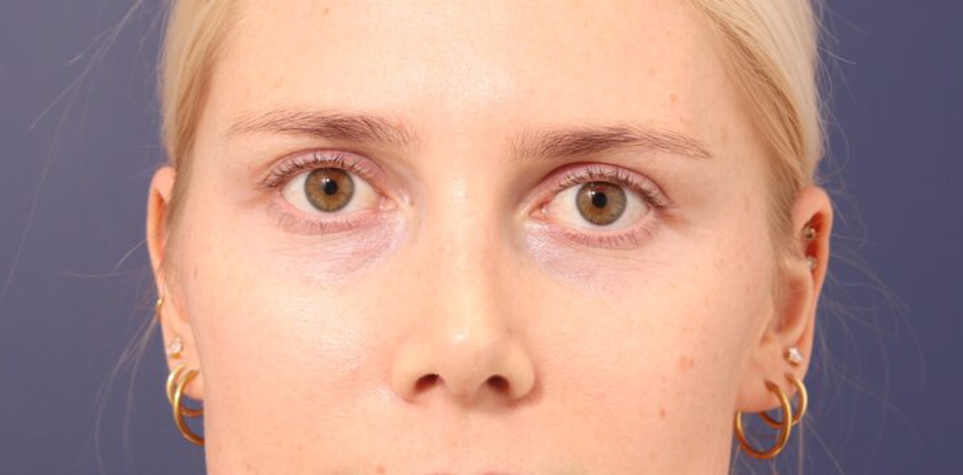 Rhinoplasty Before & After Image