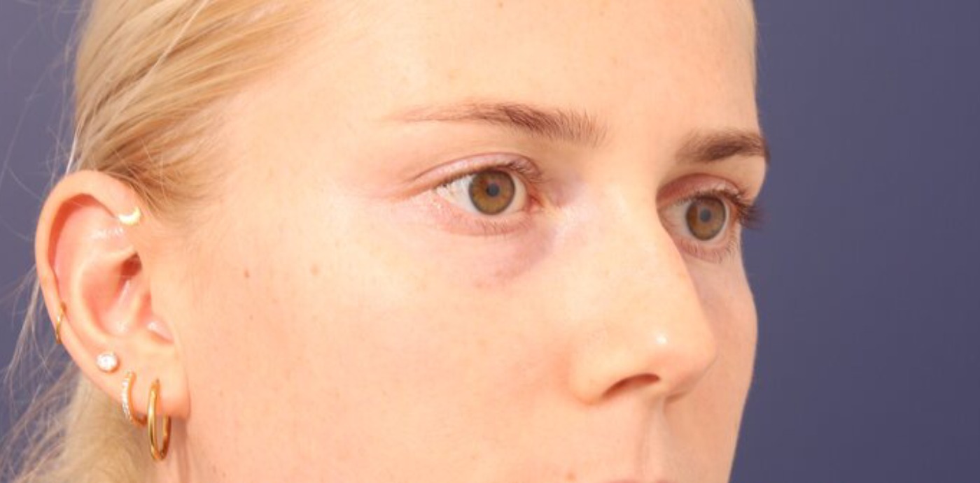 Rhinoplasty Before & After Image